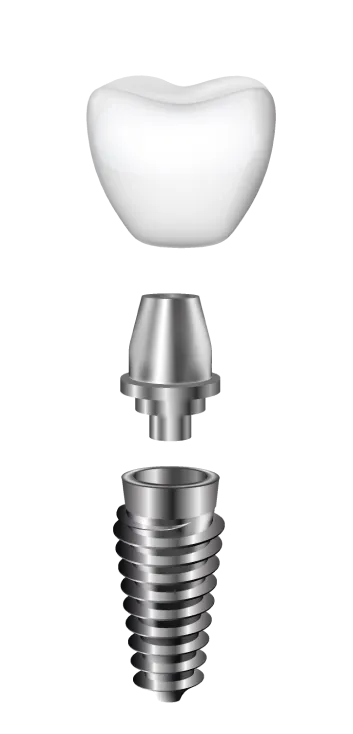 Componentele unui implant dentar