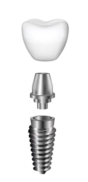Componentele unui implant dentar