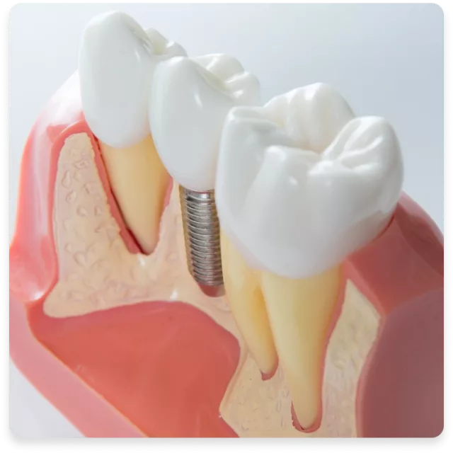 Implanturi dentare